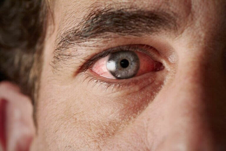 Man with dry irritated eyes