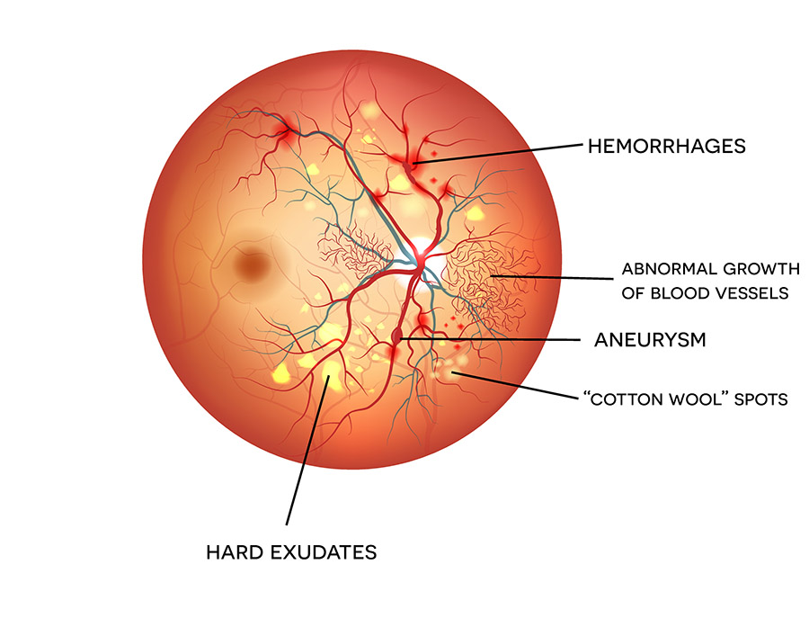 Chart illustrating how diabetes affects an eye