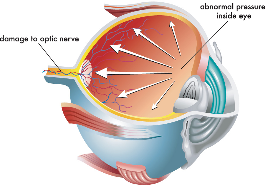 Chart illustrating how glaucoma affects an eye